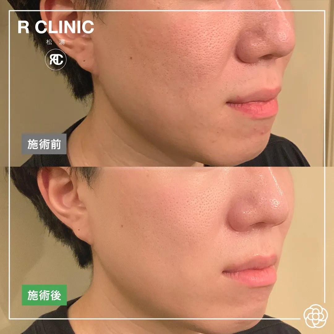 ジェネオプラス