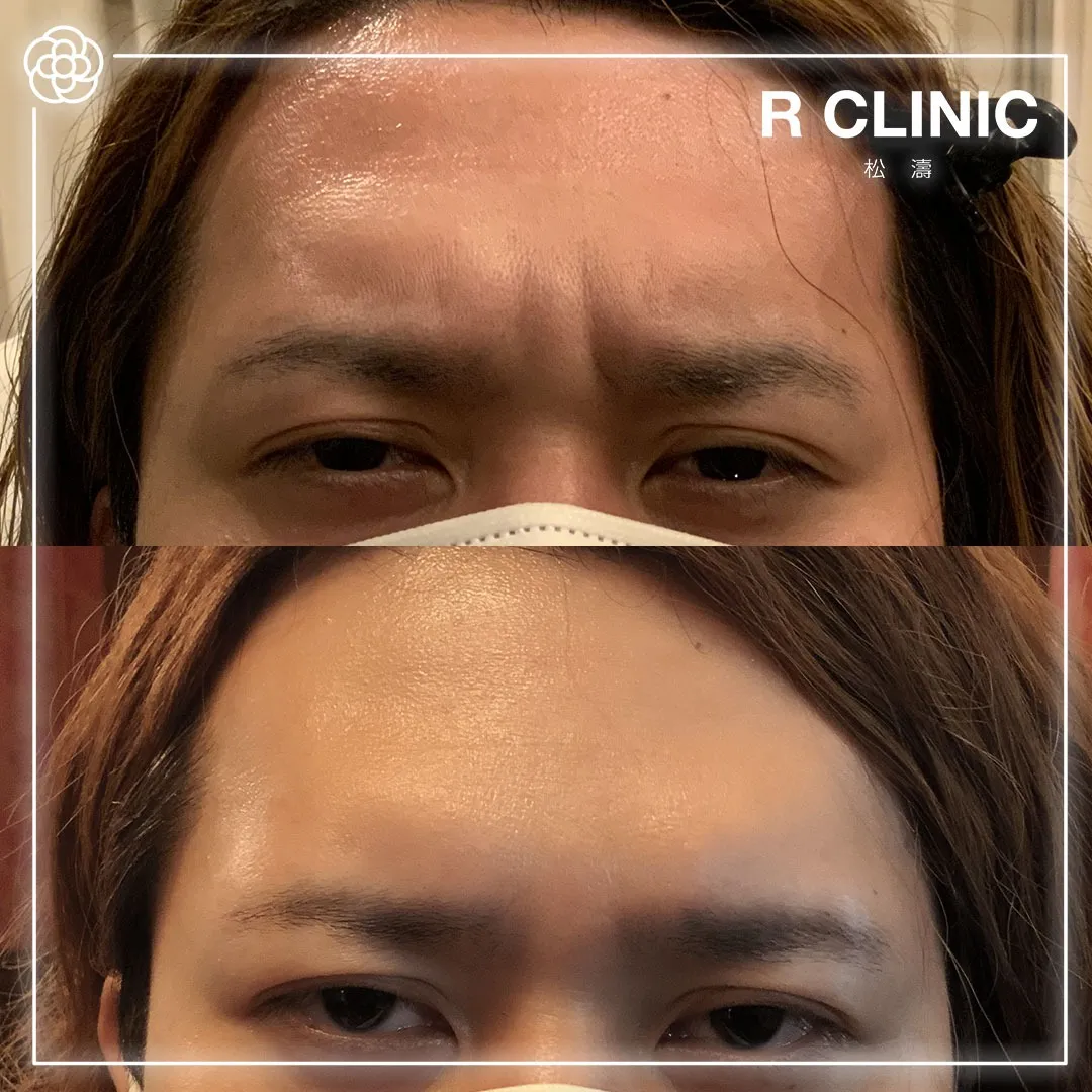 男性の眉間ボトックス